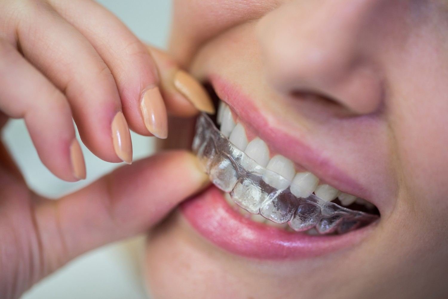 Clear Aligners in Panipat